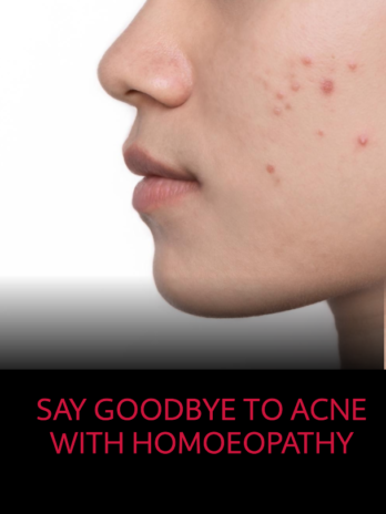 ACNE CARE